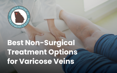 Best Non-Surgical Treatment Options for Varicose Veins