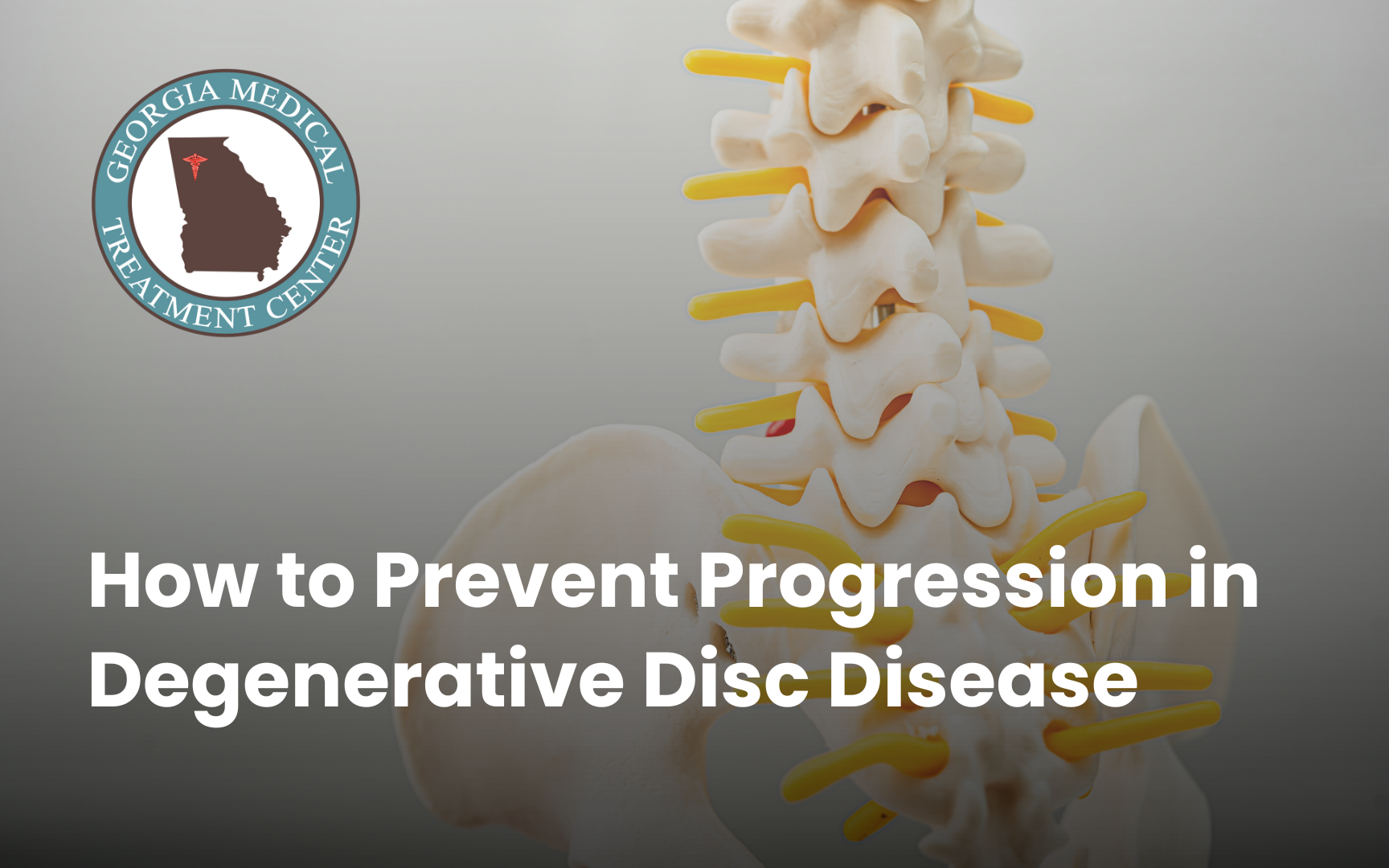 How to Prevent Progression in Degenerative Disc Disease