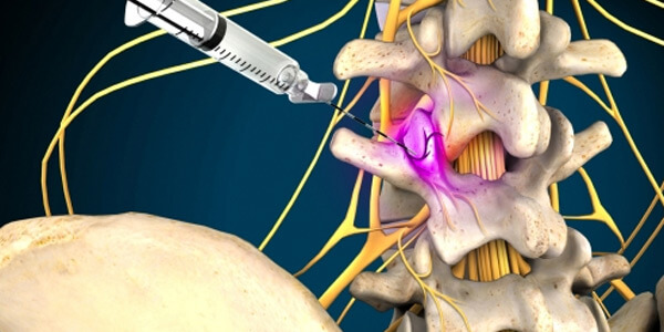 medial branch nerve treatment