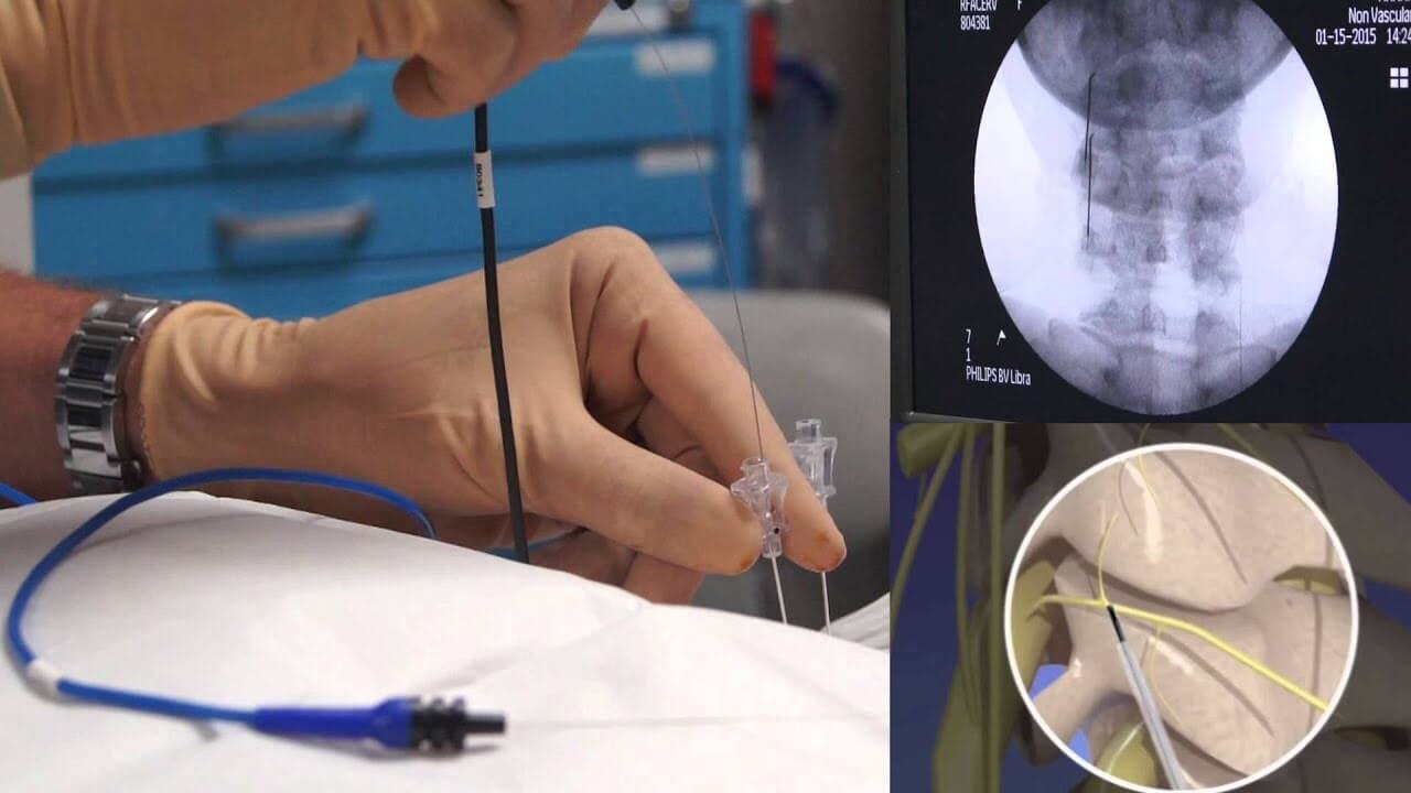 radiofrequency ablation procedure