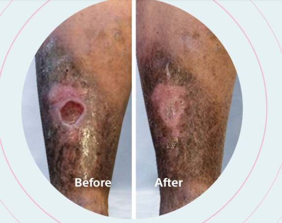 Before and after Varithena treatment