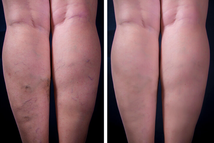 Spider Varicose Vein Treatment