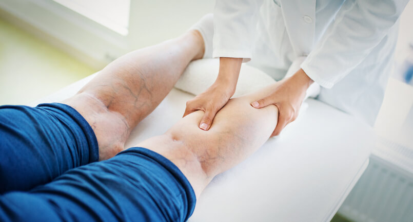 Varicose Spider Vein Treatment