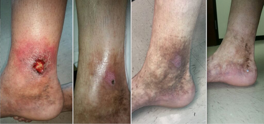 Venous ulcer Treated with Varithena chemical ablation