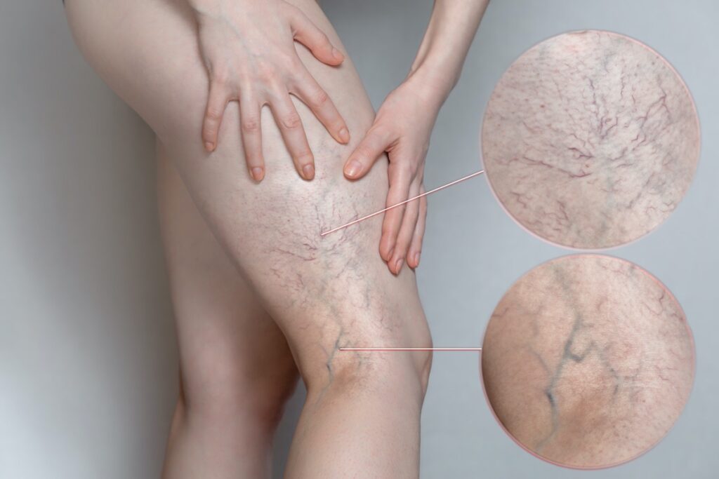 Spider Veins