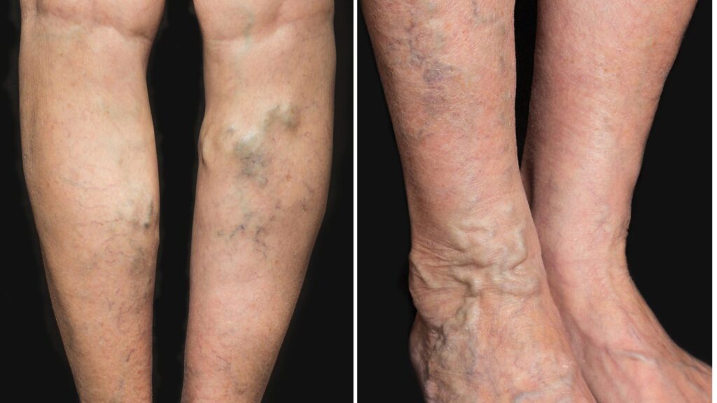 Vein Disorders