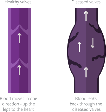 Leg Vein Valves