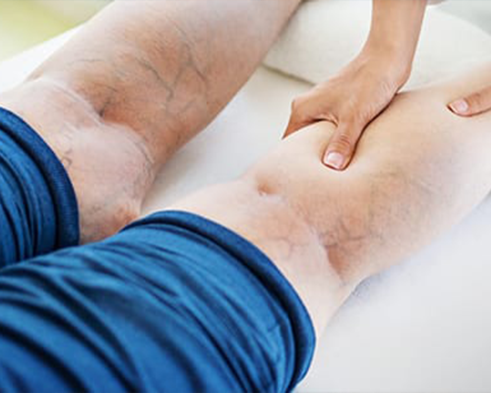 Spider Vein Treatment