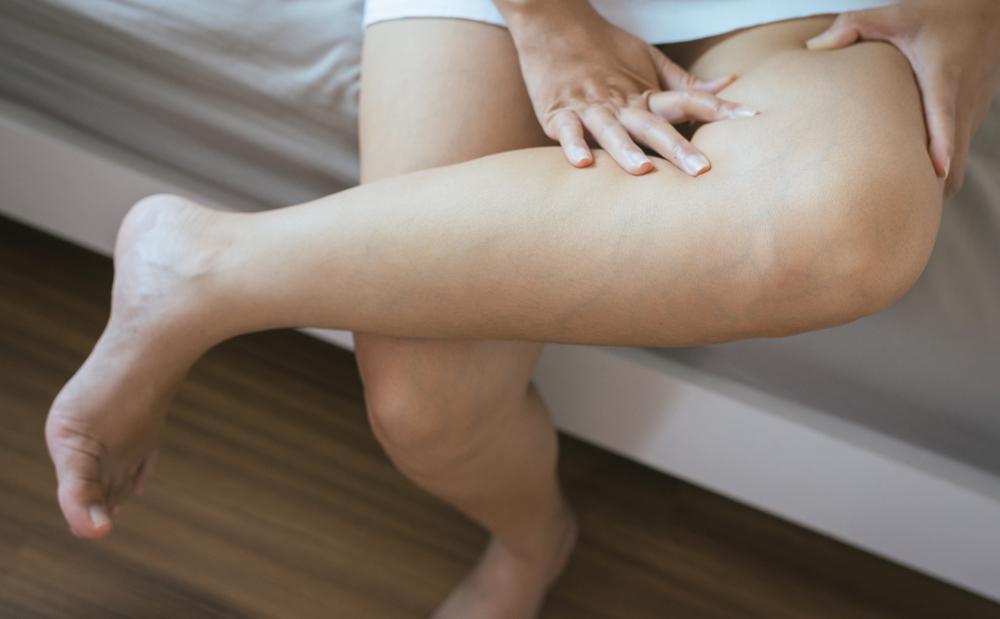 Procedures for Treating Varicose and Spider Veins